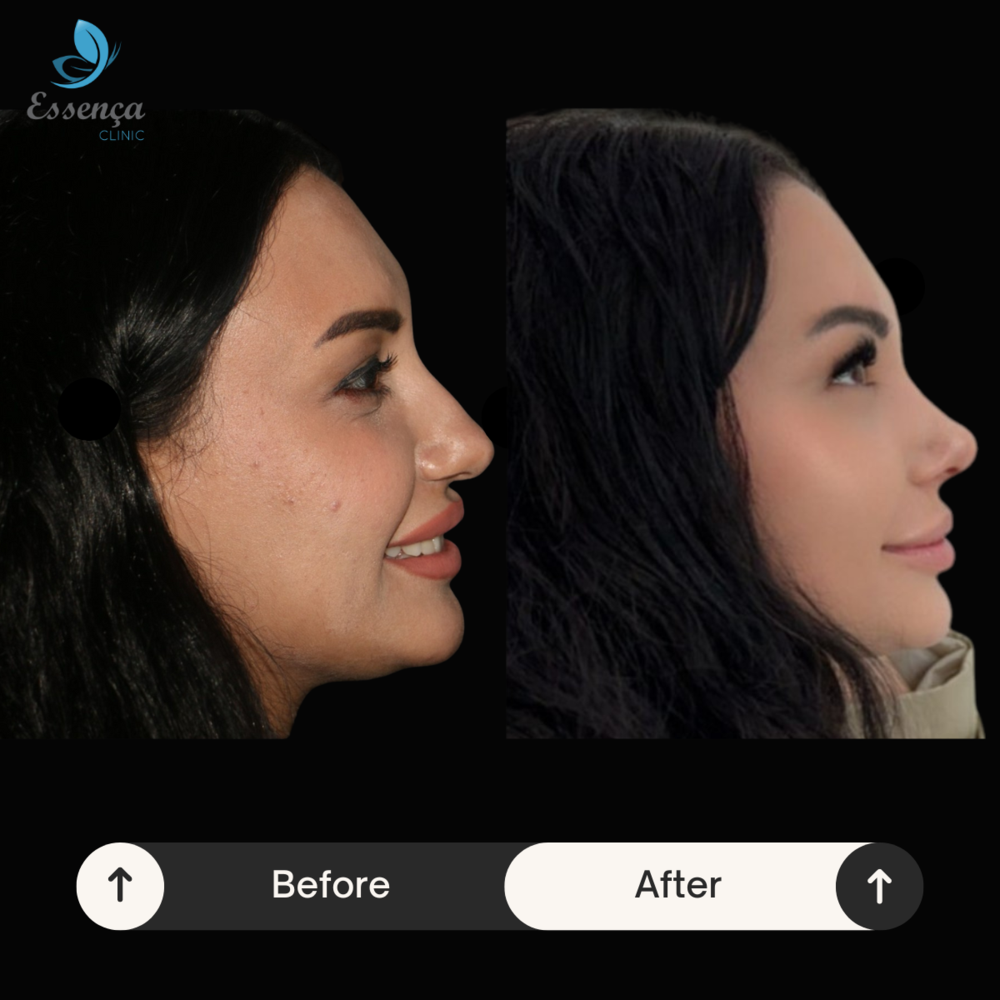 Before and After Result